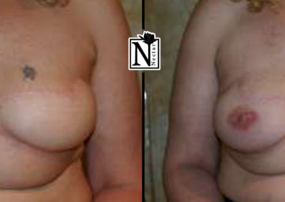 Areola Micro-Pigmentation by Nicole