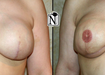 Areola Micro-Pigmentation by Nicole